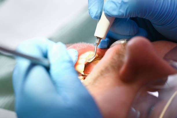 Best Emergency Tooth Extraction in Napervle, IL