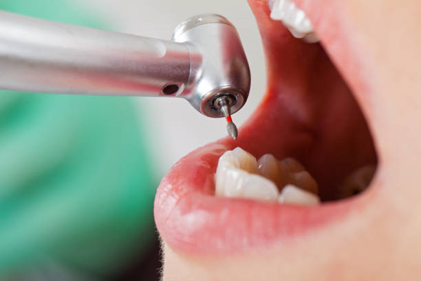 Best Emergency Tooth Extraction in Napervle, IL